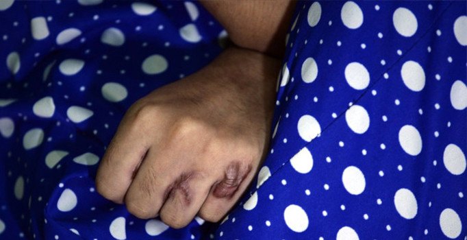 Hindistan'da bir kadın 5. kez asit saldırısına uğradı