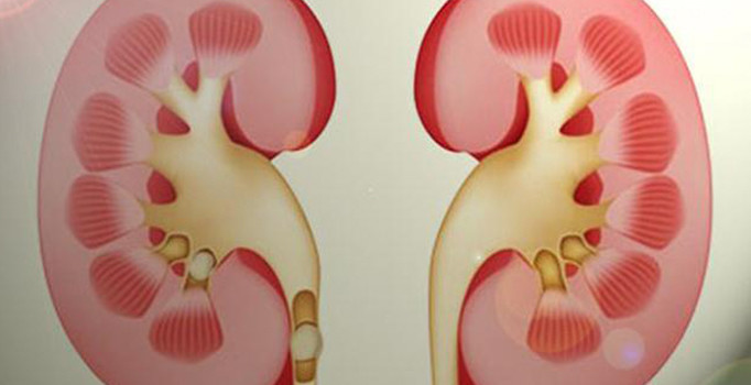 Tedavi edilen böbrek taşları 5 yıl içerisinde tekrarlayabilir