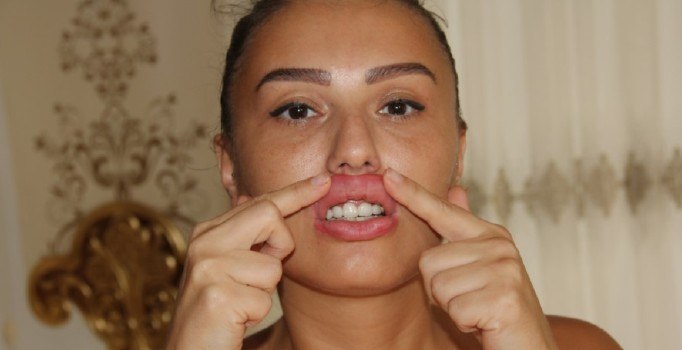 Hemşireye enjekte edilen silikon, inşaat malzemesi çıktı