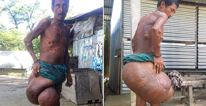 Bangladeşli adam kalçasındaki tümör yüzünden yürüyemiyor