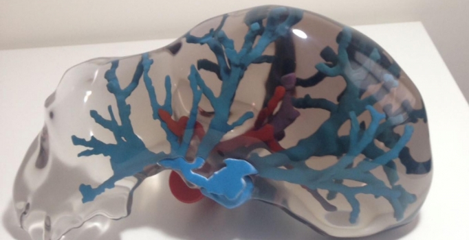 Karaciğer naklinde 3D dönemi