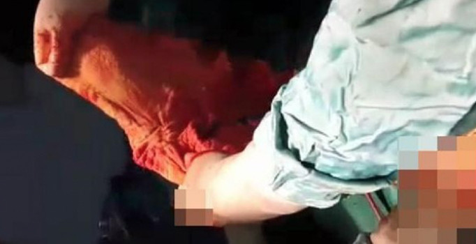 Trabzon'da kadın hastanın karnından havlu çıktı