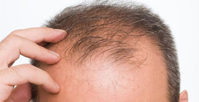 Bilim insanlarından kelliğe çare