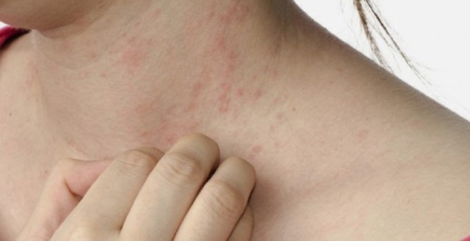 Hava sıcaklığındaki düşüşler 'egzamayı' tetikliyor