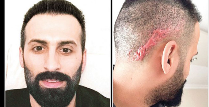 Saç ekimine giden vatandaşın kafasında 'keloid' denilen yara izi oluştu
