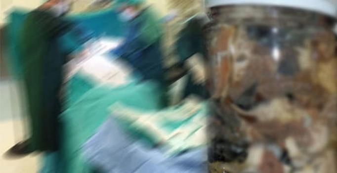 Kavanozdaki böbrek davasında 10 yıl sonra karar çıktı