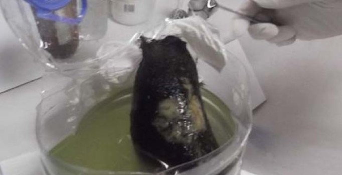 Midesinden top büyüklüğünde saç ve sakız çıktı