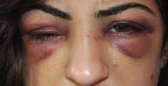 Sevgilisinin parmağını kırdı, barışmak istediği eski eşini hastanelik etti | Adana haberleri