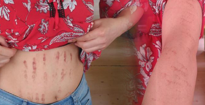 Lazer epilasyonun ardından vücudunda yanıklar oluştu