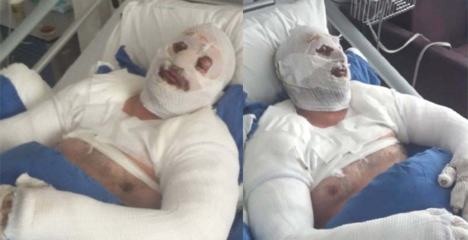 Saç kurutma makinesini çalıştırdı, patlamada bu hale geldi