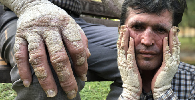Hayatı sedef hastalığı yüzünden kabusa döndü: Dışarıya çıkmaya utanır hale geldim