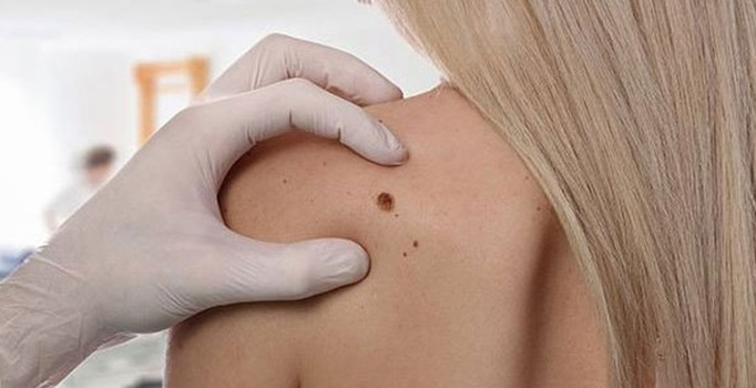 "Cilt kanseri güneşten korunarak önlenebilir"