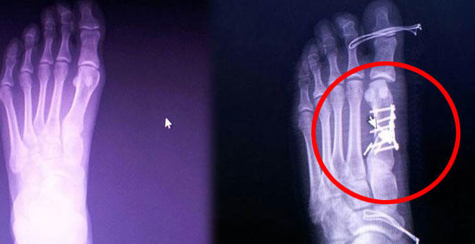 Yanlış ayağı ameliyat etti, teklifi hastayı çıldırttı