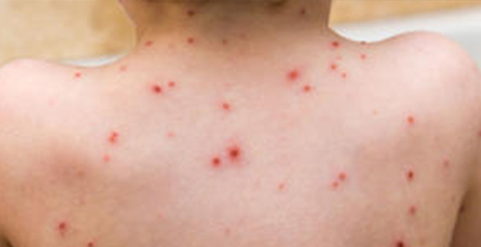 Samoa'da kızamık salgınında ölü sayısı 63'e yükseldi