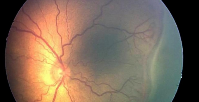 Laboratuvar retinası körlüğe çare olacak