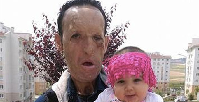 Yüz nakli olduktan sonra evlenen Recep Sert bebeğinin fotoğrafını paylaştı