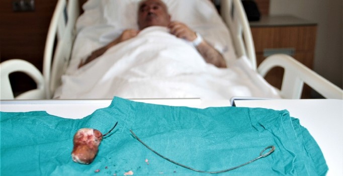 Unutulan 28 santimlik ’stent’ 7 yıl sonra fark edildi