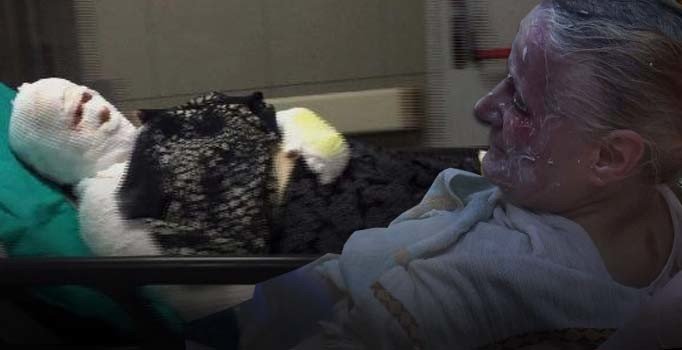 Kulak kıllarını ispirto ile temizlediği felçli eşini ve kendisini yaktı