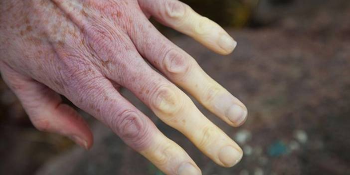 Kelebek hastalığı (lupus) nedir, belirtileri neler, nasıl tedavi edilir?