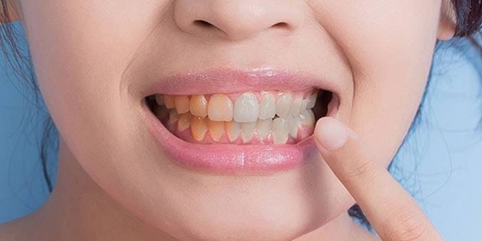 Sarı Dişlerden Kurtulabilirsiniz! Hintliler Yüz Yıllardır Bu Yöntemi Kullanıyor.. Bembeyaz Dişlere Kavuşmanın Ucuz Ve Hızlı Yolu