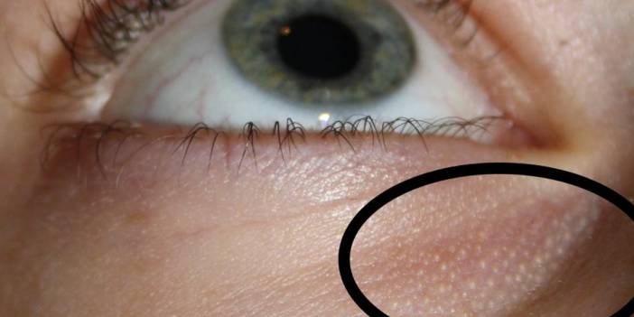 Daha Kötüsü Olmadan Hemen Önlem Alın! Göz Çevrenizde Kabarcıklar varsa Dikkat...