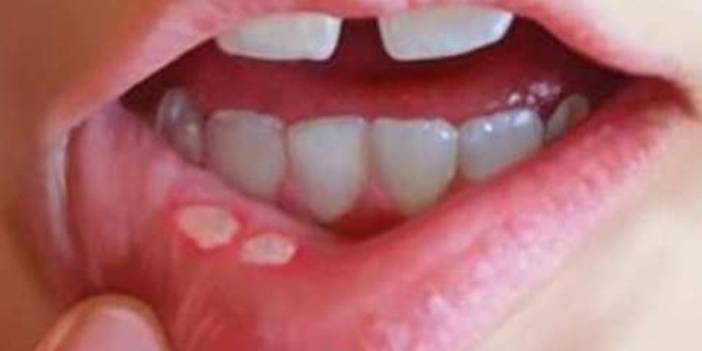 Ağız Yaralarını 1 Saat İçinde İyileştiriyor! Ağzınızdaki Aflar İçin ev Yapımı Çözümler