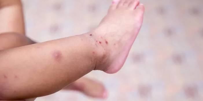 Dünyanın Yeni Kabusu Çocukları Vuruyor! Domates Gribi Alarmı... Hindistan'dan Yayılmaya Başladı! Türkiye'de Görüldü Mü?