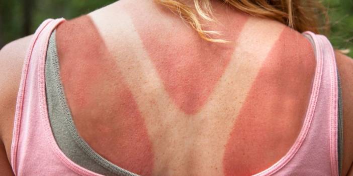 Dermatologlar Önerdi! Anında Rahatlayacaksın... Kullan Ve Bir Gece İçinde Güneş Yanıklarından Kurtul! Her Evde Var...