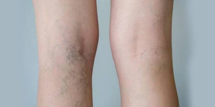 Varislerden 1 haftada kurtulmak ister misiniz? İkisini karıştırın her akşam sürün 7 gün sonra eser kalmayacak...