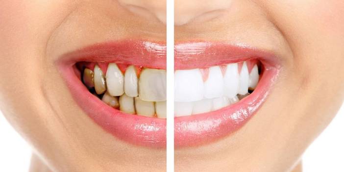 Kırk yıl düşünseniz aklınıza gelmez! Dişteki tartarları birkaç günde tamamen yok ediyor...