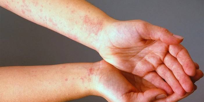 Uyuz vakalarında yüzde 40 artış! Uzmanlar başlıca belirtilerini sıraladı