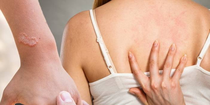 Polikliniklerin yüzde 30'u uyuz vakası: Yeni salgın kapıda mı?