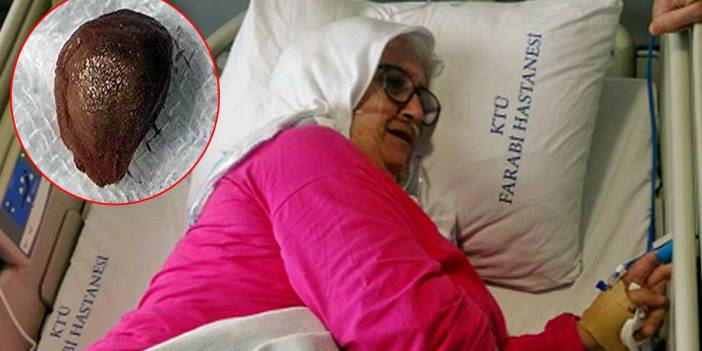 'Bir şey olmaz' diyerek yuttuğu çekirdek nedeniyle akciğerini kaybetti! 66 yaşında adeta yeniden doğdu