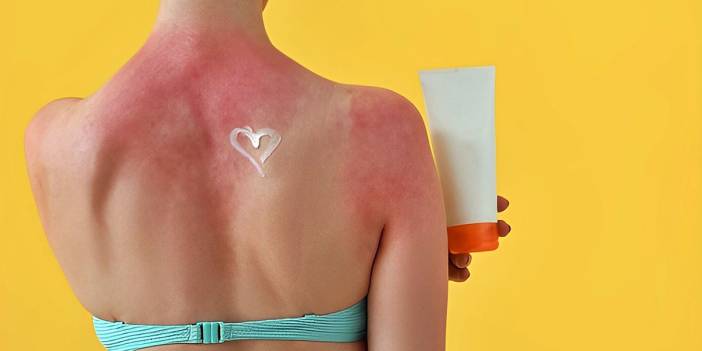 Yazın en sinsi tehlikesi: Cilt sağlığı için bunu göz ardı etmeyin! Güneş yanığı sandığınız şey aslında başka bir şey olabilir