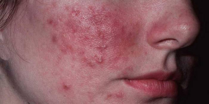 Alerji sandığımız o durum aslında bambaşka bir hastalığın belirtisiymiş! Bu yiyecekler ve alışkanlıklar hastalığı tetikliyor