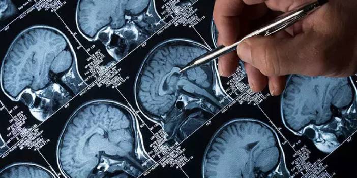 Yeni araştırma: Lityum Alzheimer’a karşı beyni koruyor