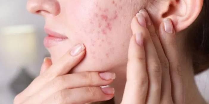 İnternette 'mucize' diye satılan ürünler cilt sorunlarına neden oluyor