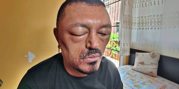 Saç siyahlaştırıcı şampuan kabusu: Gözleri şişti, kafası yara oldu!