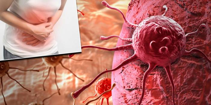 Her iki kişiden birinde görülüyor: Helicobacter pylori bakteri kanser riskini arttırabilir