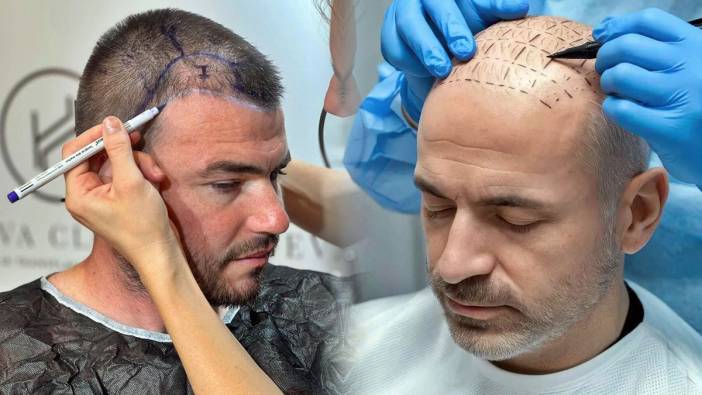 Saç ekimi ameliyatının büyük kısmı artık doktorlar tarafından yapılmayacak!