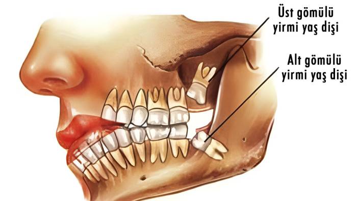 Yirmilik dişler atalarımız için süper güçtü; bizde ise sadece ağrı yapıyor!