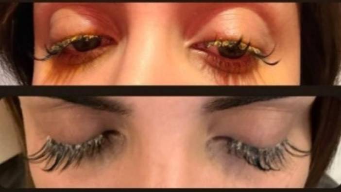 Güzellik kabusu! İpek kirpik yaptırırken gözlerinden oluyordu: Hatalı işlem yüzünden geçici görme kaybı yaşadı