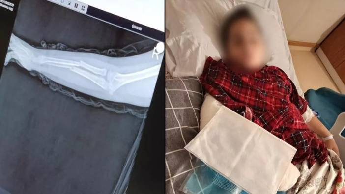 Okulda akran zorbalığı: 9 yaşındaki çocuk arkadaşının kolunu kırdı