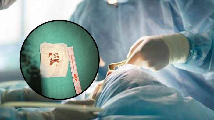Buruna kaçan peçete, kağıt deyip geçmeyin! Estetik ameliyatında şaşırtan olay! Burun boşluğundan taş çıktı