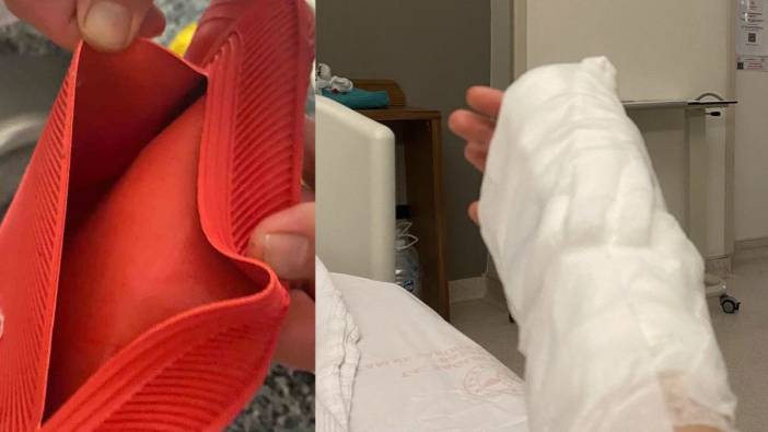 Sıcak su torbası patladı, genç kızın vücudunun yüzde 25’i yandı! 'Kış aylarında benzer vakalar artıyor'