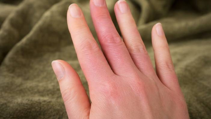 Parmaklardaki mavi-mor renk değişimine dikkat: "Raynaud Fenomeni" habercisi olabilir! Peki nedir bu "Raynaud Fenomeni?"