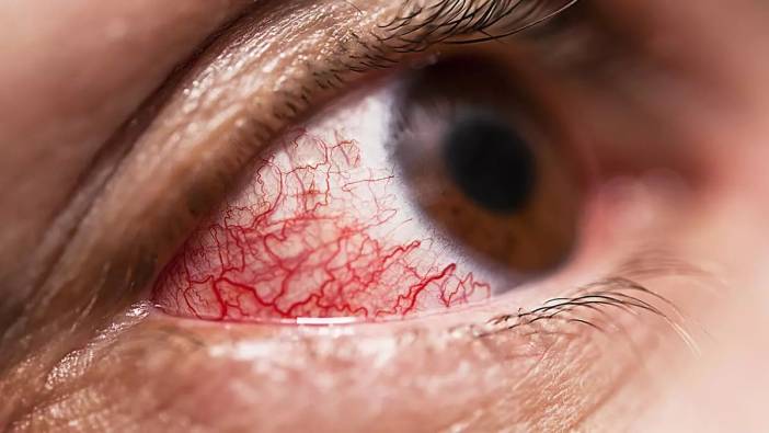 Göz kızarıklığı deyip geçmeyin, sonu karanlık olabilir! Uzman isimden 'Üveit' uyarısı: Körlükle sonuçlanabilir