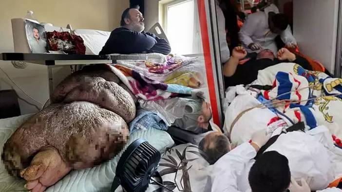 Hem obezite hem fil hastası olan adam, duvarlar kırılarak evden çıkarılabildi