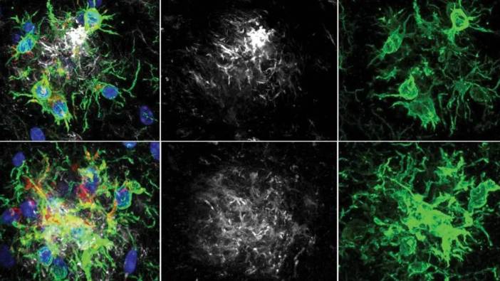 Alzheimer’a karşı yeni umut: Beynin savunma hücreleri yeniden aktive edildi