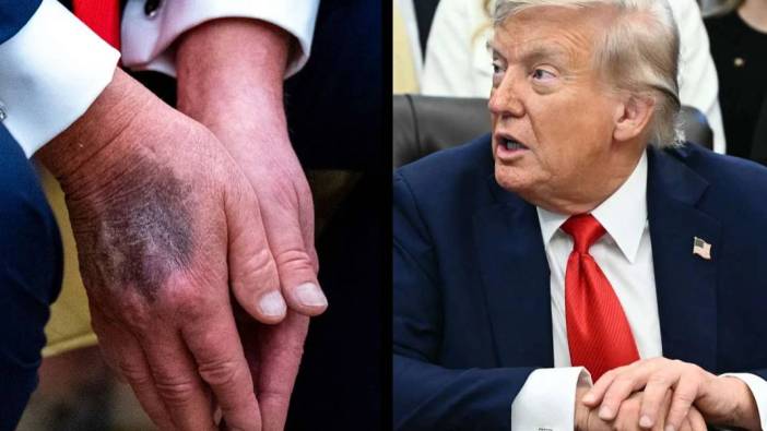 Trump’ın 'mükemmel' sağlık raporu tartışma yarattı: Ellerindeki morluklara cevap yok